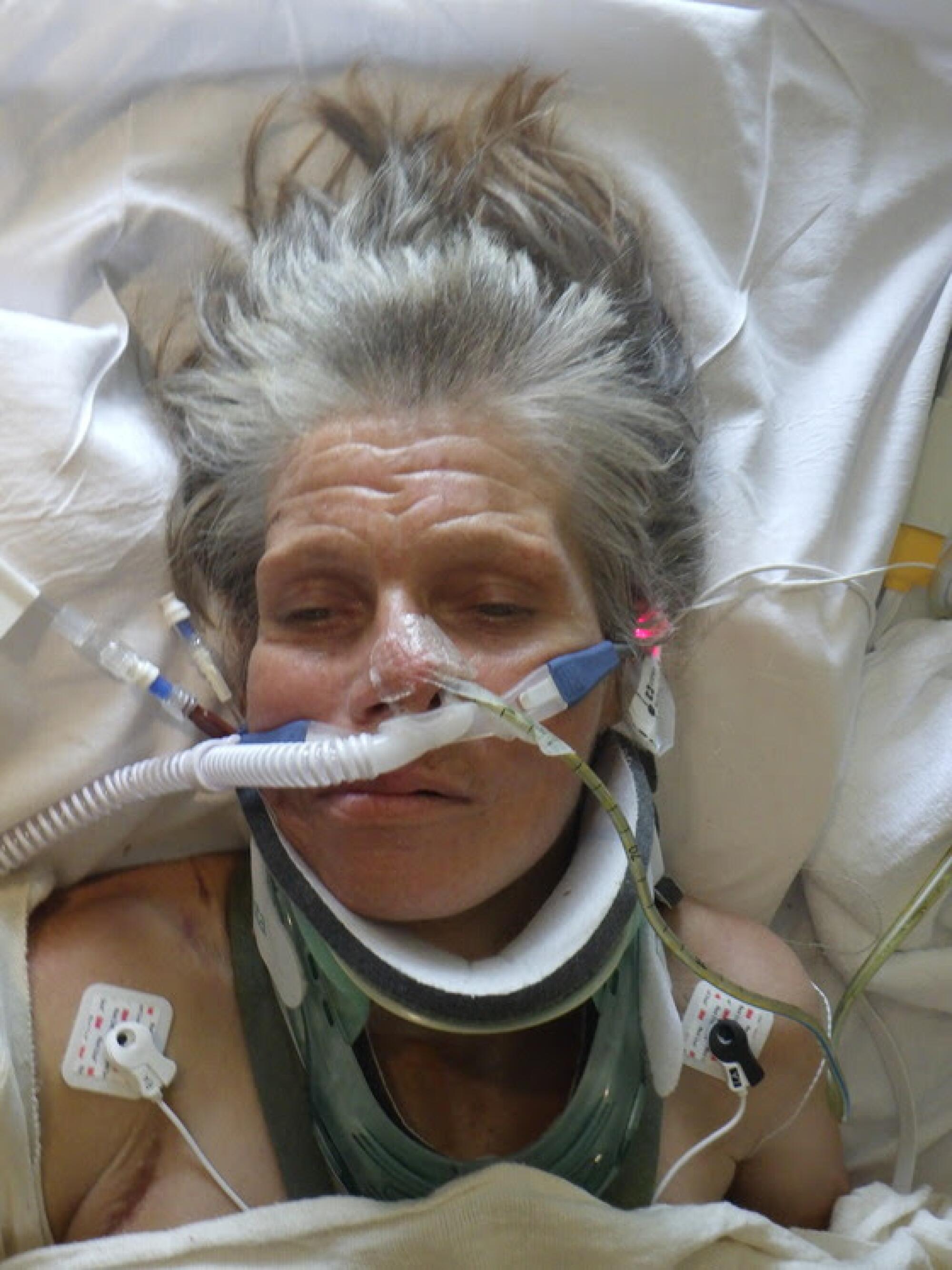An intubated woman lays in a hospital bed with eyes closed.