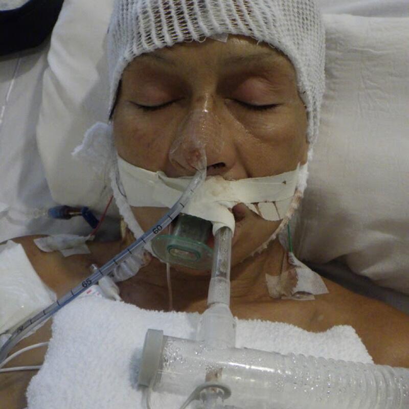 a woman lays in a hospital bed intubated