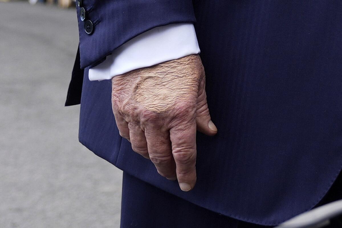 What to know about chronic venous insufficiency — President Trump’s health diagnosis